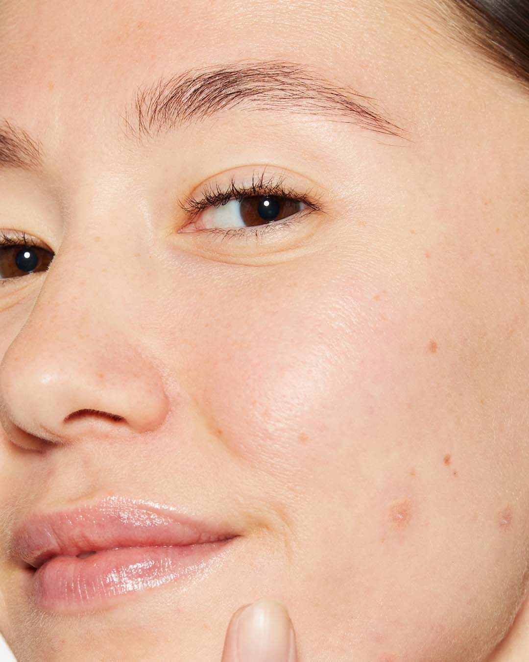 Pickel bei Erwachsenen und Teenagern: Die Unterschiede + was man gegen Unreinheiten machen kann