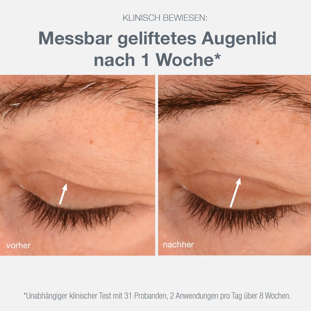 Vorher- und Nachher-Fotos eines Augenlids, die eine Verbesserung der Hautstruktur zeigt