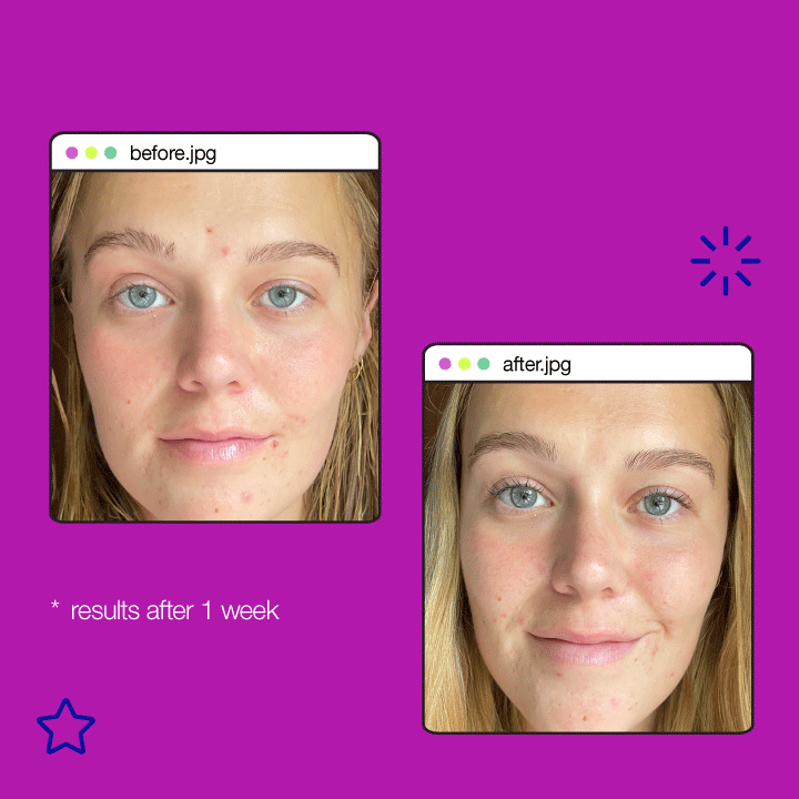 Vorher-Nachher-Vergleichsbilder einer Person mit unreiner Haut vor und verbesserter Hautkomplexion nach der Anwendung eines Hautpflegeprodukts über eine Woche.