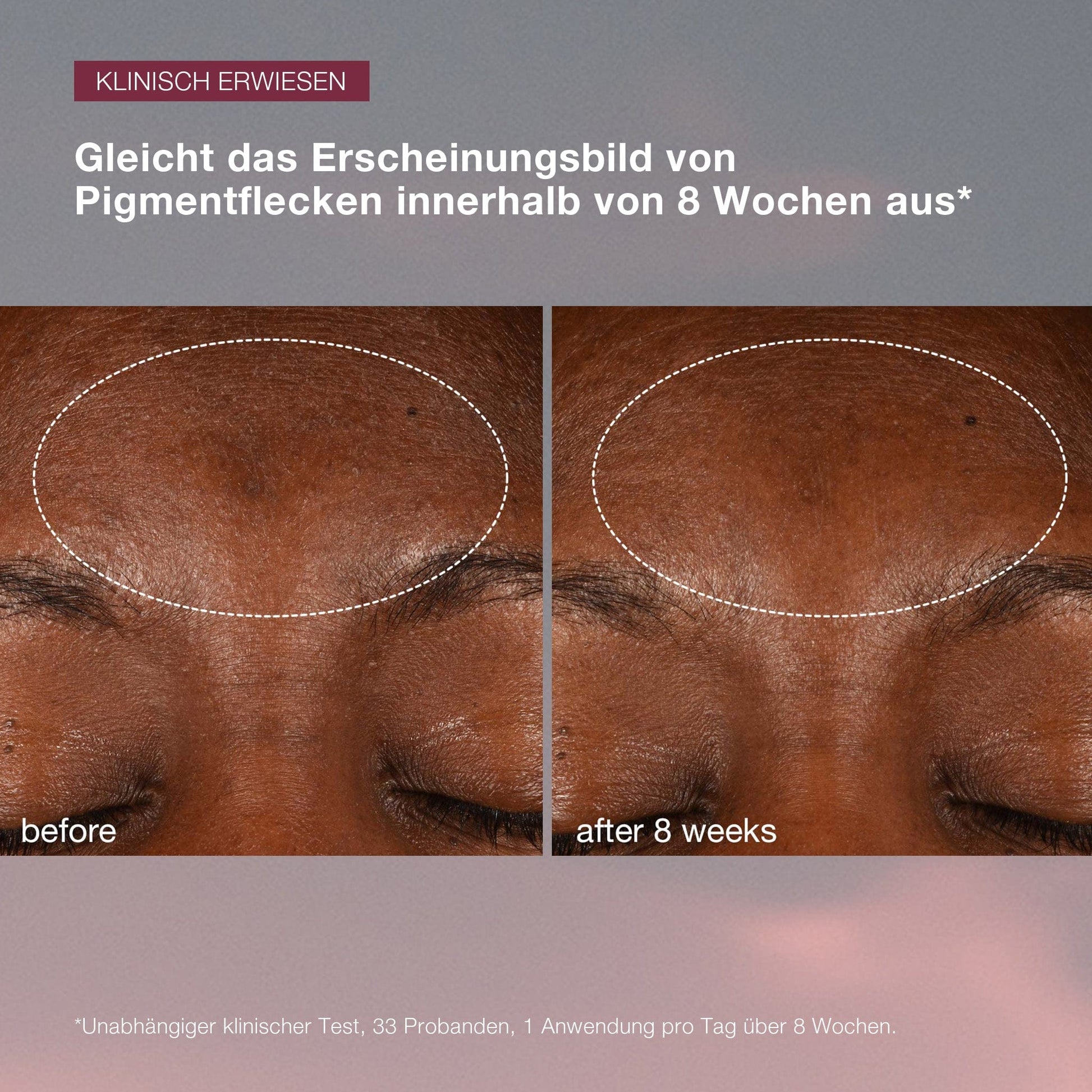 Vorher- und Nachher-Fotos, die die Verringerung der Pigmentierung auf der Stirn einer Person über 8 Wochen zeigen, markiert mit einem Kreis, verbessert durch Dynamic Skin Recovery SPF50 | Tagespflege mit SPF.