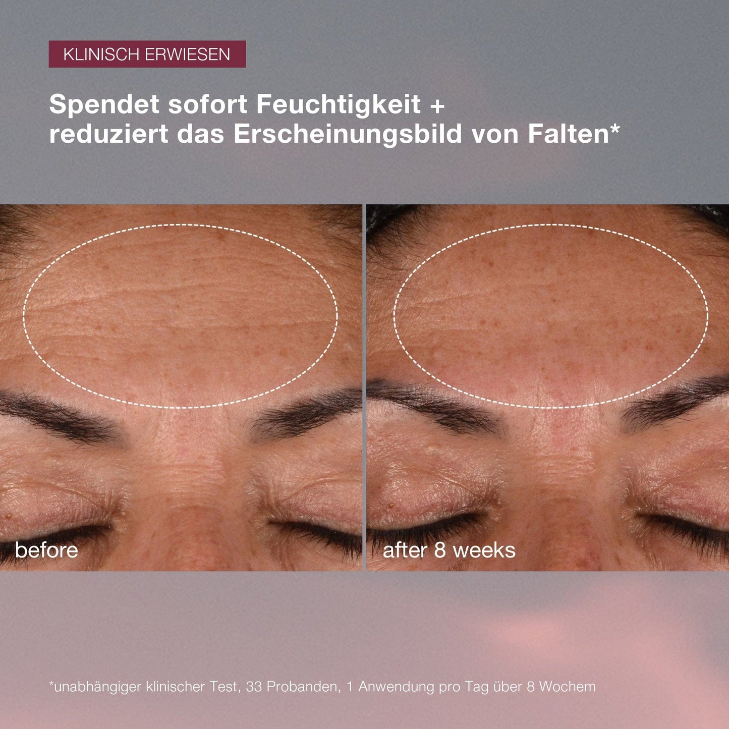Vorher- und Nachher-Bilder einer Stirn, die eine Verringerung der Faltenbildung nach 8 Wochen Dynamic Skin Recovery SPF50 zeigen | Tagespflege mit SPF-Hautpflegebehandlung.