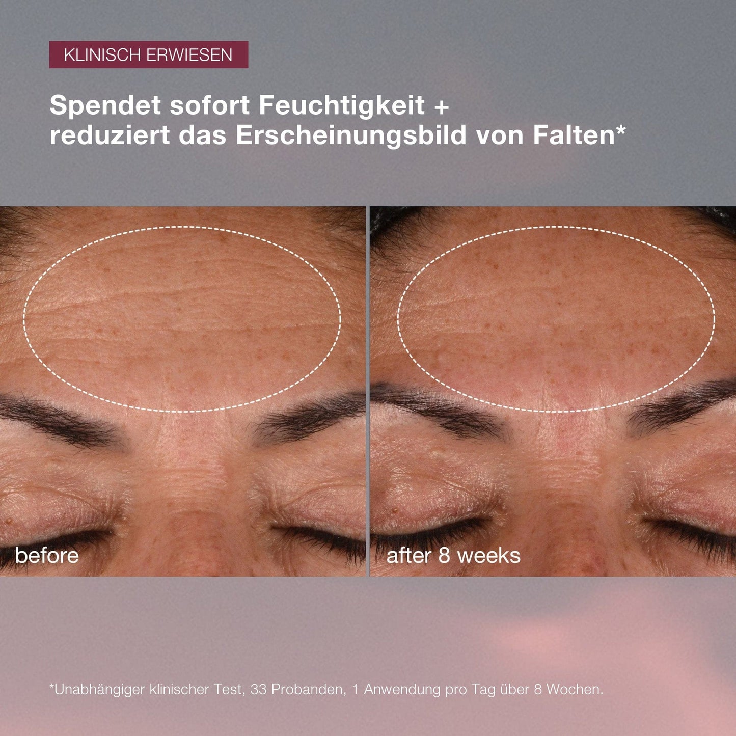 Nahaufnahme der Stirn einer Person, die die Ergebnisse vor und nach einer 8-wöchigen Behandlung mit Dynamic Skin Recovery SPF50 | Tagespflege mit SPF zeigt und die Verringerung der Fältchenbildung hervorhebt.