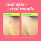 Zwei nebeneinanderstehende Bilder einer Hautpartie mit dem Titel "real skin real results" oben. Das linke Bild mit der Überschrift "vorher" zeigt die Haut mit Rötungen und Pickeln, das rechte Bild mit der Überschrift "nachher" zeigt eine Verbesserung der Haut nach einer Woche Anwendung des Clarifying Body Sprays.