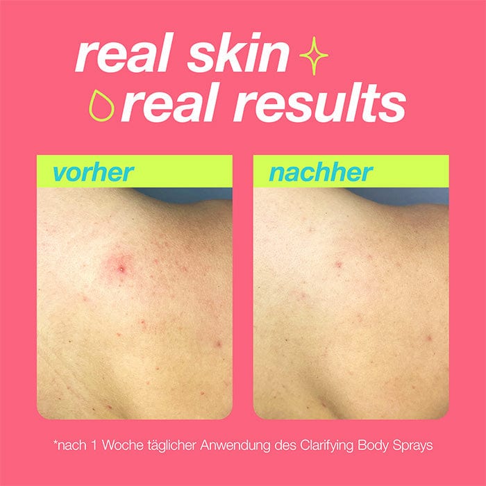 Zwei nebeneinanderstehende Bilder einer Hautpartie mit dem Titel "real skin real results" oben. Das linke Bild mit der Überschrift "vorher" zeigt die Haut mit Rötungen und Pickeln, das rechte Bild mit der Überschrift "nachher" zeigt eine Verbesserung der Haut nach einer Woche Anwendung des Clarifying Body Sprays.