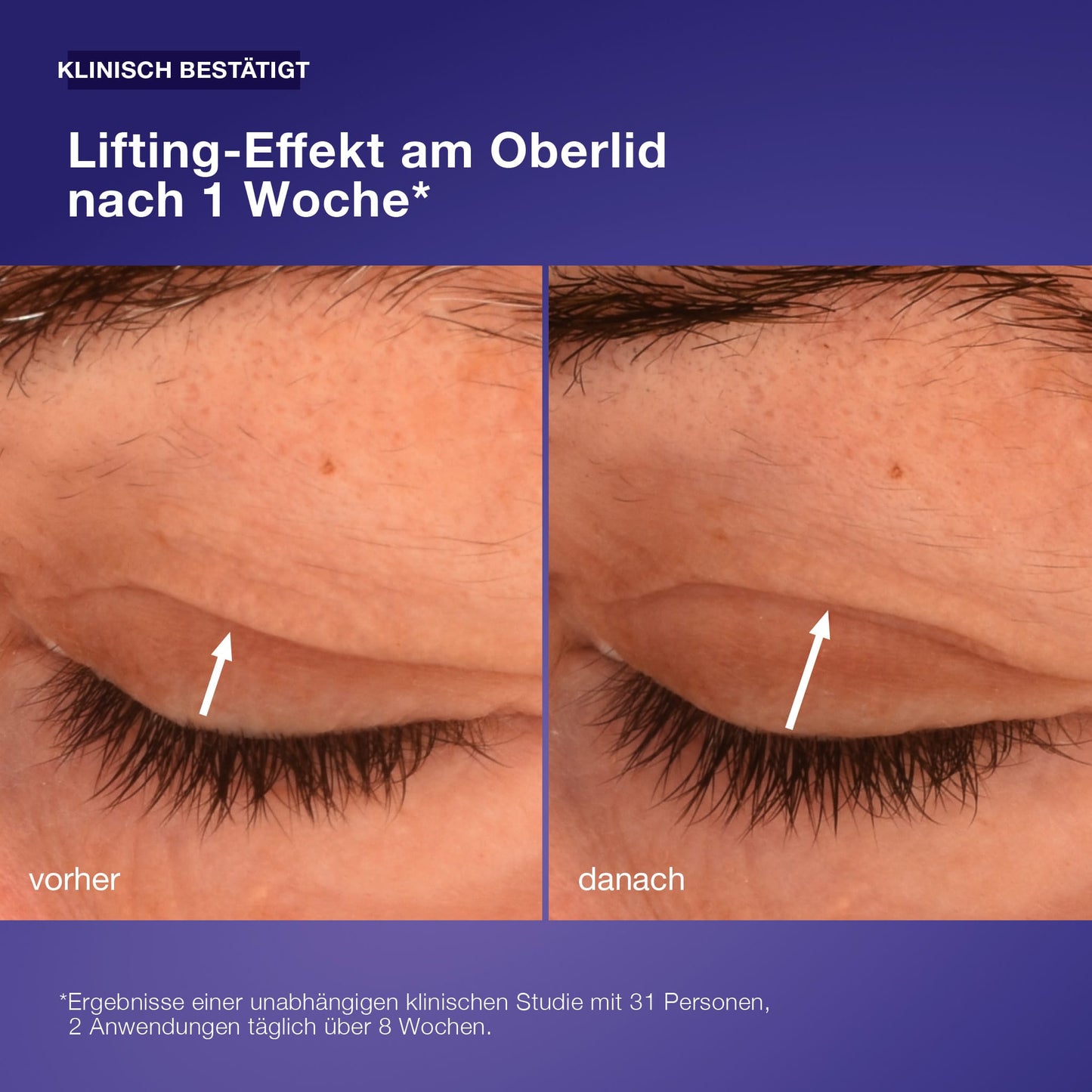 Direkter Vergleich eines oberen Augenlids vor und nach einer Woche Anwendung von Phyto Nature Lifting Eye Cream zeigt sichtbaren Lifting-Effekt; deutscher Text erläutert klinische Ergebnisse zur Straffung des Augenlids.