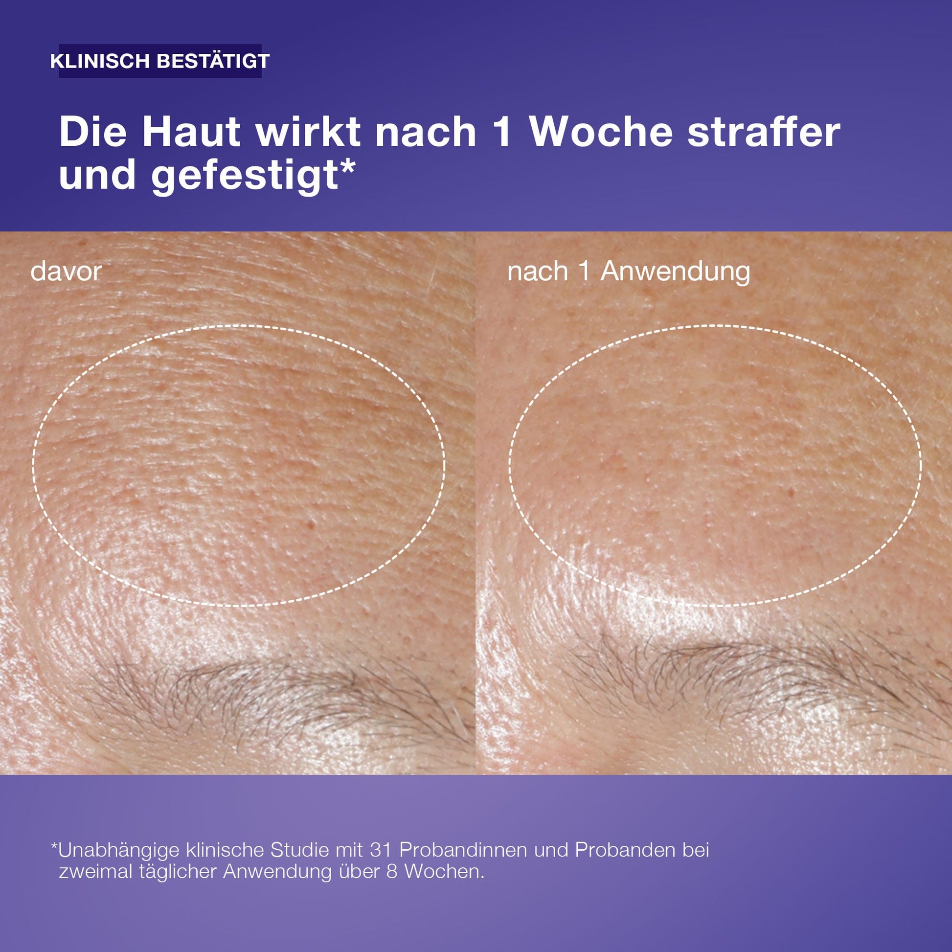Eine Nahaufnahme zeigt ein glatteres, strafferes Hautbild nach 1 Anwendung der Phyto Nature Oxygen Cream. Klinische Tests bestätigen die Anti-Aging-Wirkung der straffenden Feuchtigkeitspflege gegen Hautalterung.