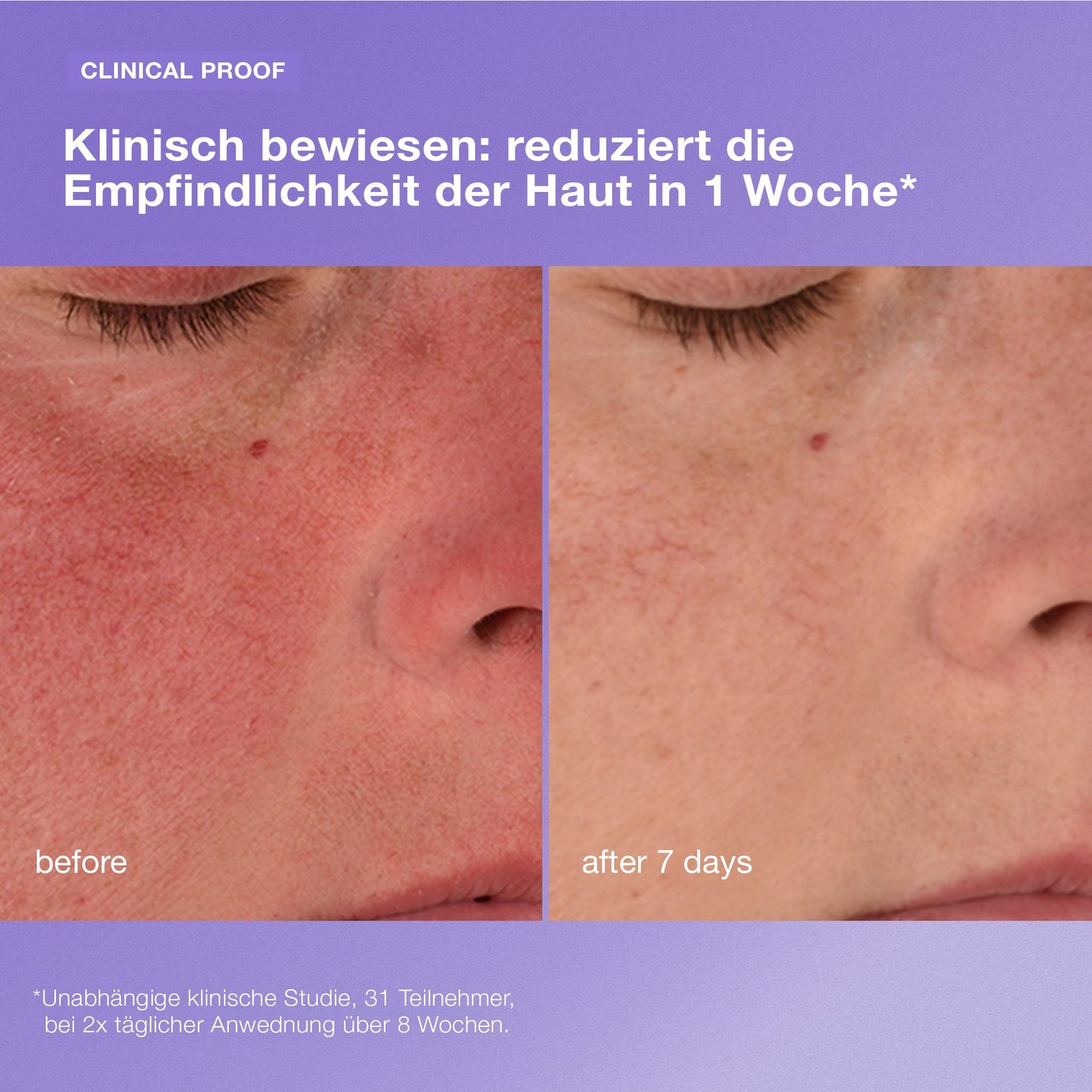 Nahaufnahme der empfindlichen Wangenhaut vor und nach 7 Tagen mit verminderter Rötung und Empfindlichkeit; der deutsche Text hebt die klinisch nachgewiesenen Ergebnisse der Stabilisierenden Reparaturcreme hervor.