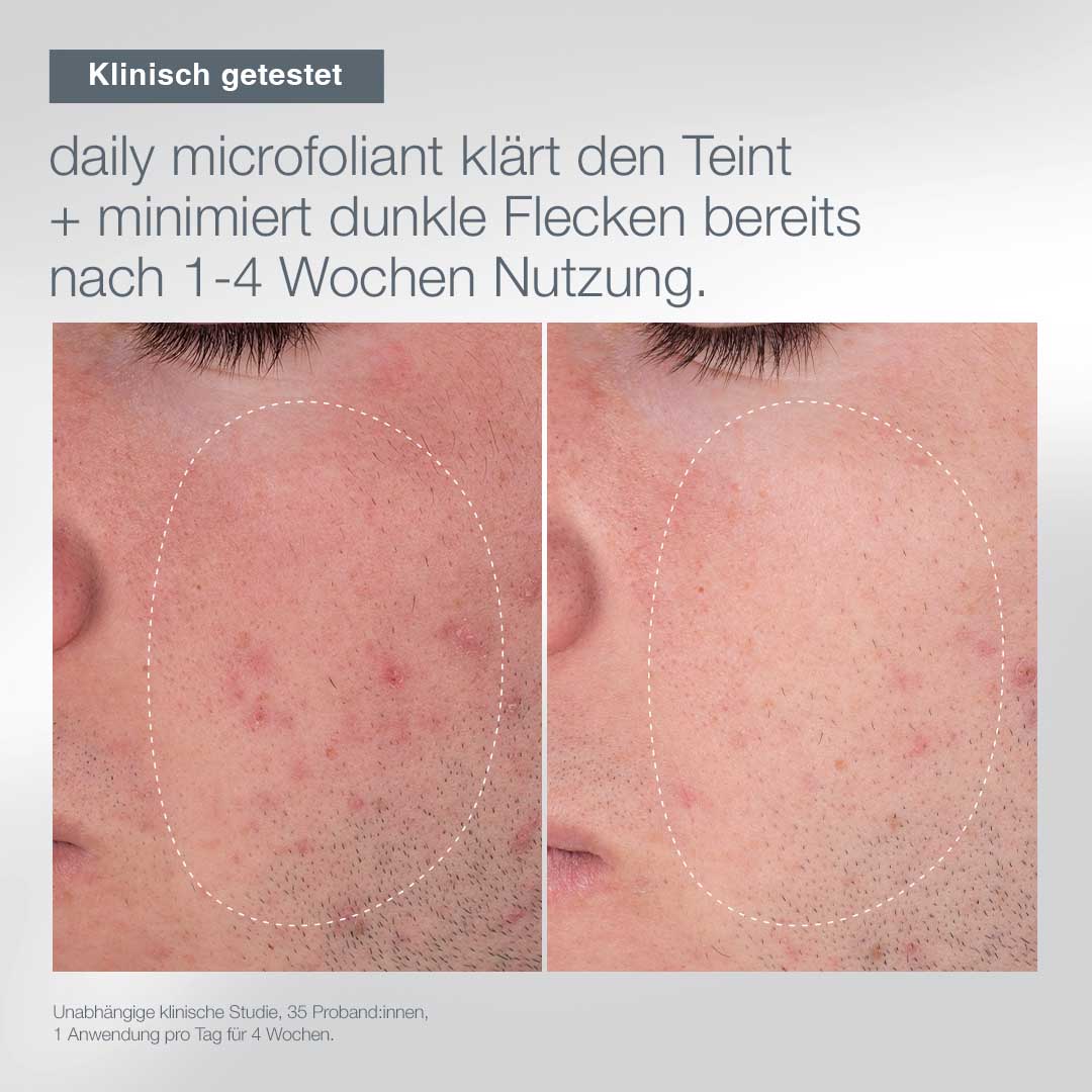 Nahaufnahme der Wangen einer Person vor und nach der Anwendung des First Snow of the Season Sets für 1-4 Wochen. Das Nachher-Bild zeigt eine glattere Haut mit weniger Rötungen und dunklen Flecken.