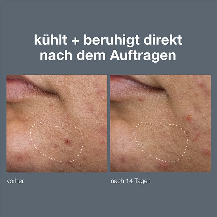 Vorher-Nachher-Vergleich einer Hautpartie, links mit Rötungen und einer sichtbaren Irritation, rechts nach 14 Tagen mit verbesserter Hauttextur und reduzierten Rötungen innerhalb der markierten Bereich.