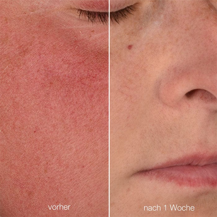 Das Gesicht einer Frau vor und nach einer Hautbehandlung mit Beruhigender Pflege für empfindliche Haut.