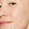Unreine, reife Haut