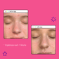 Zwei Bilder des Gesichts einer Frau mit der Aufschrift „Breakout Clearing Liquid Peel |“. Gesichtspeeling bei unreiner Haut und Pickel.